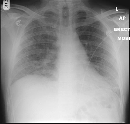 CGD patient who developed mulch pneumonitis - Aspergillus and Aspergillosis