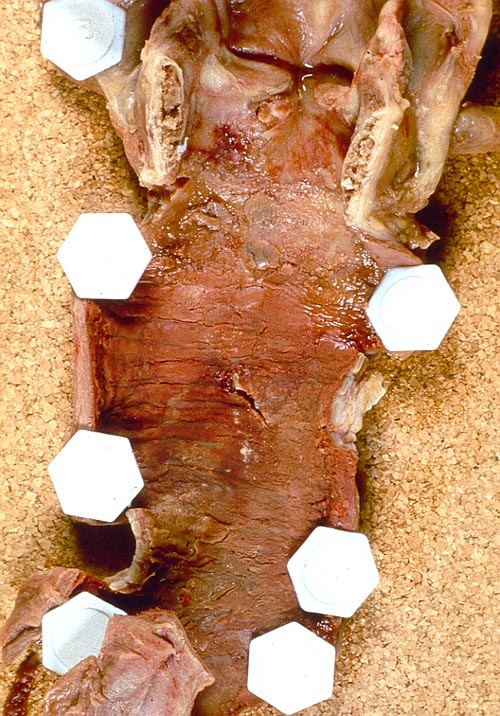 (A) Tracheal appearance at autopsy (after removal of slough) showing remarkable erythema and ulceration down to carina (Tait 1993). 