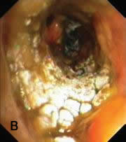 Pseudomembranous seen overlying the bronchial mucosa (Tasci 2006).