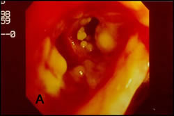 Invasive tracheobronchitis showing numerous nodules seen during bronchoscopy (Ronan D’Driscoll).