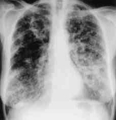 Chest X-ray showing poorly defined bilateral nodular opacities (Al-Alawi 2007).