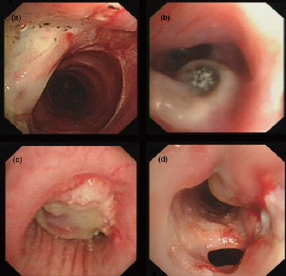 Bronchoscopic manifestations of <em>Aspergillus</em> tracheobronchitis. (a) Type I. Inflammatory infiltration, mucosa hyperaemia and plaques of pseudomembrane formation in the lumen without obvious airway occlusion. (b) Type II. Deep ulceration of the bronchial wall. (c) Type III. Significant airway occlusion by thick mucous plugs full of <em>Aspergillus</em> without definite deeper tissue invasion. (d) Type IV. Extensive tissue necrosis and pseudomembrane formation in the lumen with airway structures and severe airway occlusion (Wu 2009).