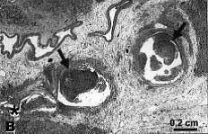 fibrinonecrotic material (arrow) from the airway shown in A, with subocclusion of the bronchial lumen (*);