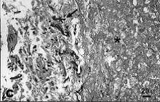 Aspergillus hyphae (arrow) in the lumen without invasion of the necrotic bronchial wall (*) (Nicod 2001).