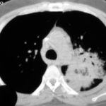  Pneumothorax (left) in a leukaemia patient 