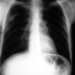 This patient has a right upper zone area of consolidation. A needle aspiration confirmed the diagnosis of invasive pulmonary aspergillosis. This failed to improve with itraconazole therapy.