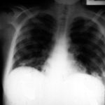 Severe bilateral diffuse and nodular invasive pulmonary aspergillosis in an allogenic bone marrow transplant recipient with dyspnoea, hypoxia and dry cough.