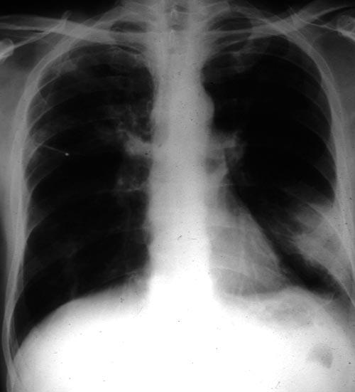 Image A. Chest radiograph of a leukaemic man showing an area of consolidation at the left base, abutting on the pleura and some faint soft shadowing at the right apex. 