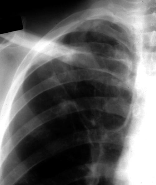 Image A. December 1991 Close up view of right upper-lobe of the lung in a 45 year old man who smoked cigarettes showing an ill-defined shadow behind the clavicle and additional abnormalities inferior to this in the right upper-lobe.