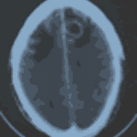 Brain abscess 2