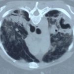 Image A. Aspergilloma complicating sarcoidosis patient DB