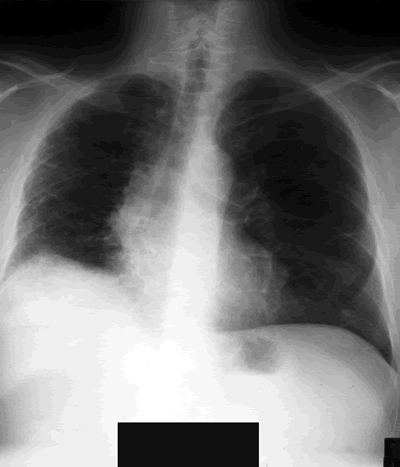 Lung transplant patient with a left lower lobe bronchial stent ...