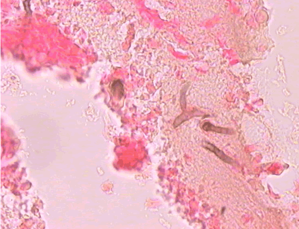 Light Microscopy Of Mucus Sections Aspergillus And Aspergillosis