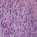 Image A (& B) are right lung biopsies showing fragments of bronchial mucosa with a relatively heavy inflammatory cell infiltrate with prominent eosinophils. There is basement layer thickening and goblet cells are focally prominent.