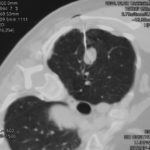 Aspergilloma. Patient EW Percutaneous lung biopsy