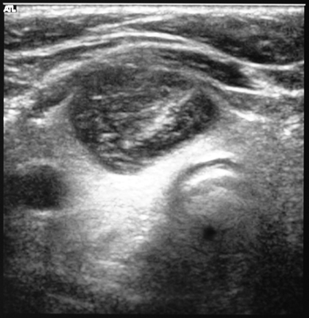 Thyroiditis and abscess caused by A. fumigatus. Patient JO ...