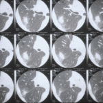  Multiple slices of a high resolution Ct scan showing an irregular nodule surrounded by a ground glass attenuation - the halo sign.