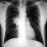 Recurrent pulmonary shadows 1, pt BJ