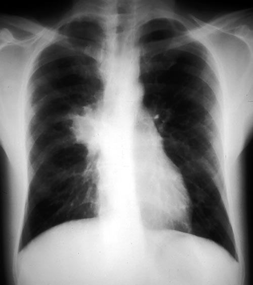 Recurrent pulmonary shadows 1, pt BJ