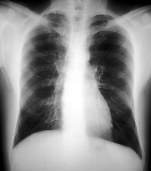 Clearing Of Pulmonary Shadows 3, Pt BJ - Aspergillus And Aspergillosis