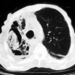 Image A. CT scan of the thorax showing a large apical aspergilloma in the largest of several cavities in the right lung.