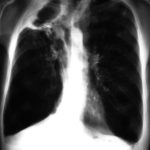 Right apical cavity, patient DT