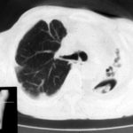 Left apical cavity, patient BF. Aspergilloma/chronic necrotising pulmonary aspergillosis