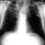 This patient with severe pulmonary sarcoidosis has bilateral aspergillomas.