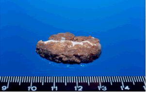 Multiple aspergillomas, Patient CR. The same specimen showed in adjacent figure. Cut section revealing hyphal growth in zones.