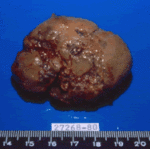 Patient AS. Dead fungal ball. Gross pathological appearance of dead fungus ball.