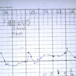 Fever chart of Pt CA.