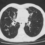 Image A. Patient with longstanding ABPA, showing some bronchiectasis in the right lung and considerable mucous plugging particularly around the main bronchi.