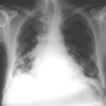 Image A. Chest x-ray June 2000. Recent onset pleural pulmonary infection with Aspergillus complicating corticosteroid therapy for Wegener's granulomatosis, that had responded to therapy.