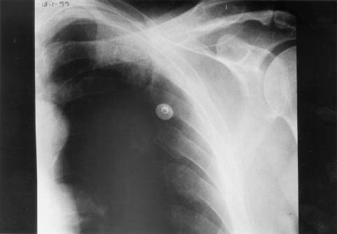 Image A. pt. DM Primary Aspergillus pneumonia (13.1.99)