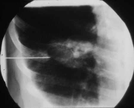 Chest x ray showing needle biopsy - Aspergillus and Aspergillosis