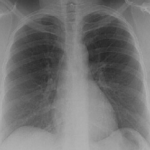 Image A. Normal chest X ray