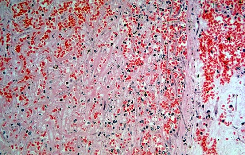 Vascular thrombosis