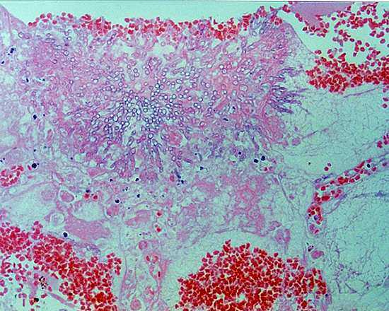 Pulmonary aspergillosis