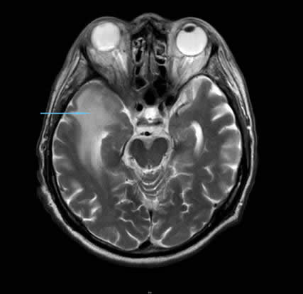 Image A. MRI (T2-weighted, transversal view).Note oedema of the right temporal lobe.