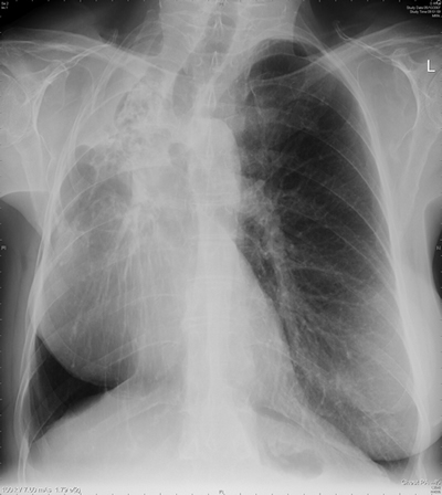 Image A. Chest X ray -fibrosis of the right upper lobe and pleural thickening. 