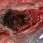 Fig2b (enlargement of fig 2) Left main bronchus