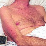 Itraconazole rash