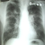 Chest x ray of patient one month prior to admission 