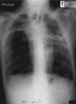 Chest X Ray 22/12/00