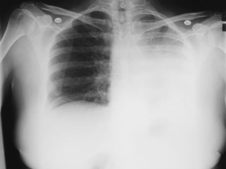 Image A. Her chest x-ray (Oct 04) shows consolidation of her left lower lobe with slight mediastinal shift, but some diaphragmatic elevation.