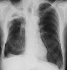 Pt FM Chronic pulmonary aspergillosis xray 1