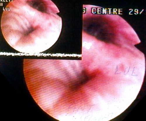 bronchial oedema