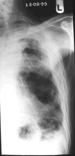 Chest X-ray  18/8/99 (left side)