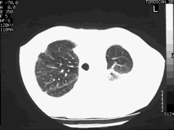 30/3/99 Note one small cavity at apex of left lung