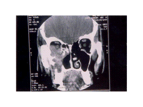 Chronic invasive sinus aspergillosis caused by Aspergillus terreus